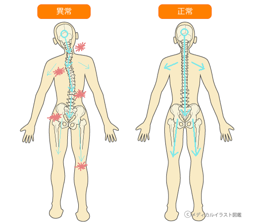 歪んだ骨格（異常）と正常な骨格の比較イラスト。歪みが神経や筋肉に負担をかけ、全身に痛み・しびれが広がる様子